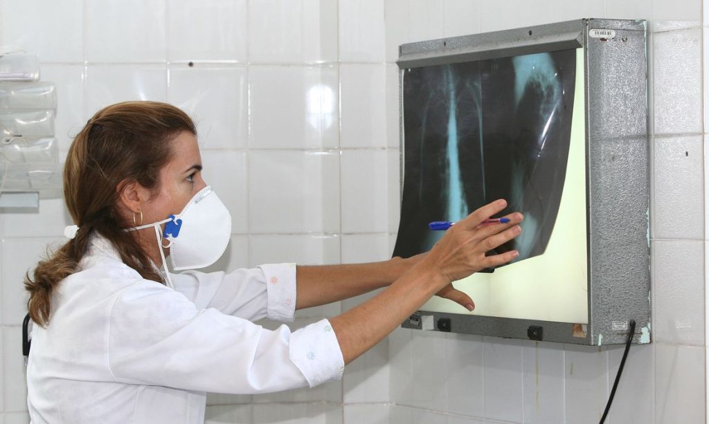 Com aumento de 5%, Brasil registra 78 mil casos de tuberculose